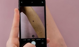 В Беларуси рак кожи будут вычислять с помощью искусственного интеллекта 